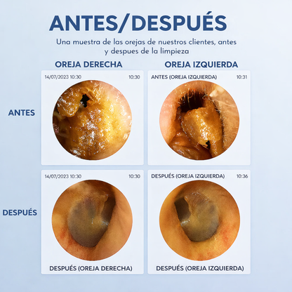 WaxClean™ - Limpieza de oídos inteligente con tecnología avanzada + 7 PZ ACERO INOXIDABLE